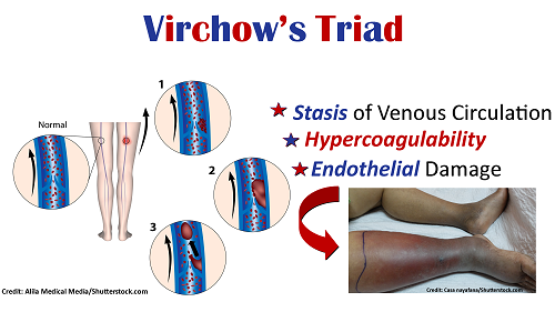 Virchow’s Triad