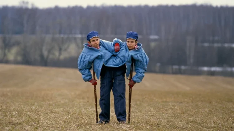 Famous Conjoined Twins: A Deep Dive into Their Lives and Stories